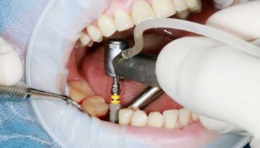 Dental Implants