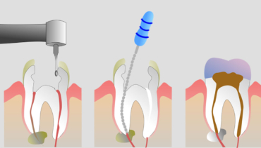 Painless Root Canal