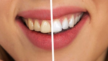 Instant Tooth Whitening