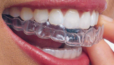 Invisalign